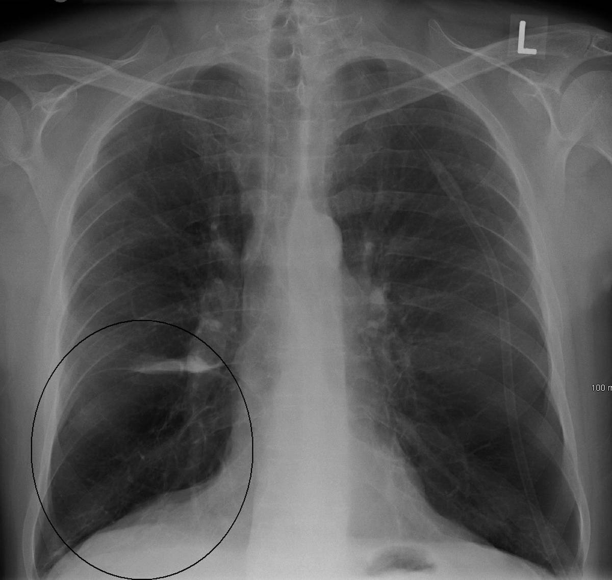 BullaCXR_Bildgröße ändern (c) Lung bulla as seen on CXR in a person with severe COPD associated with anti 1 antitrypsin deficiency.
(c) James Heilman, MD