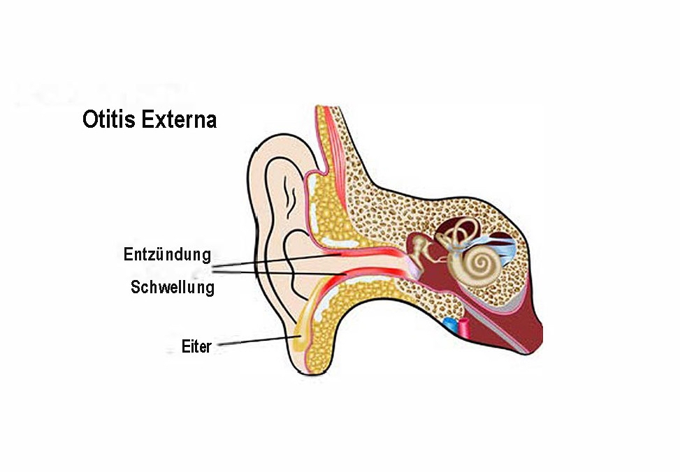 OtitisExterna-Deutsch-JPG (c) Inflammation of the ear canal
(c) Changed according to Ekaterina Murasheva: Types of Otitis